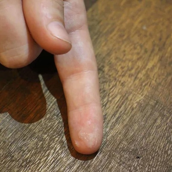 Очищаем пальцы от суперклея бережно и быстро